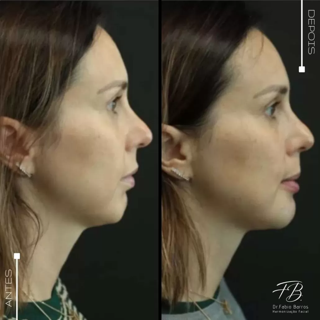 Benefícios da Harmonização Facial Definitiva com Próteses Faciais, por Dr. Fabio Barros