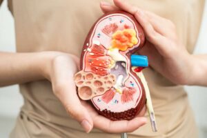 Doença Renal Crônica: Sintomas, Estágios, Creatinina, TFG, Tratamentos e Como Evitar a Progressão