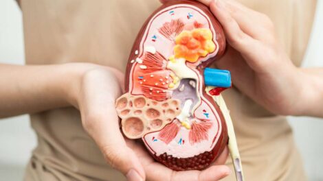 Doença Renal Crônica: Sintomas, Estágios, Creatinina, TFG, Tratamentos e Como Evitar a Progressão